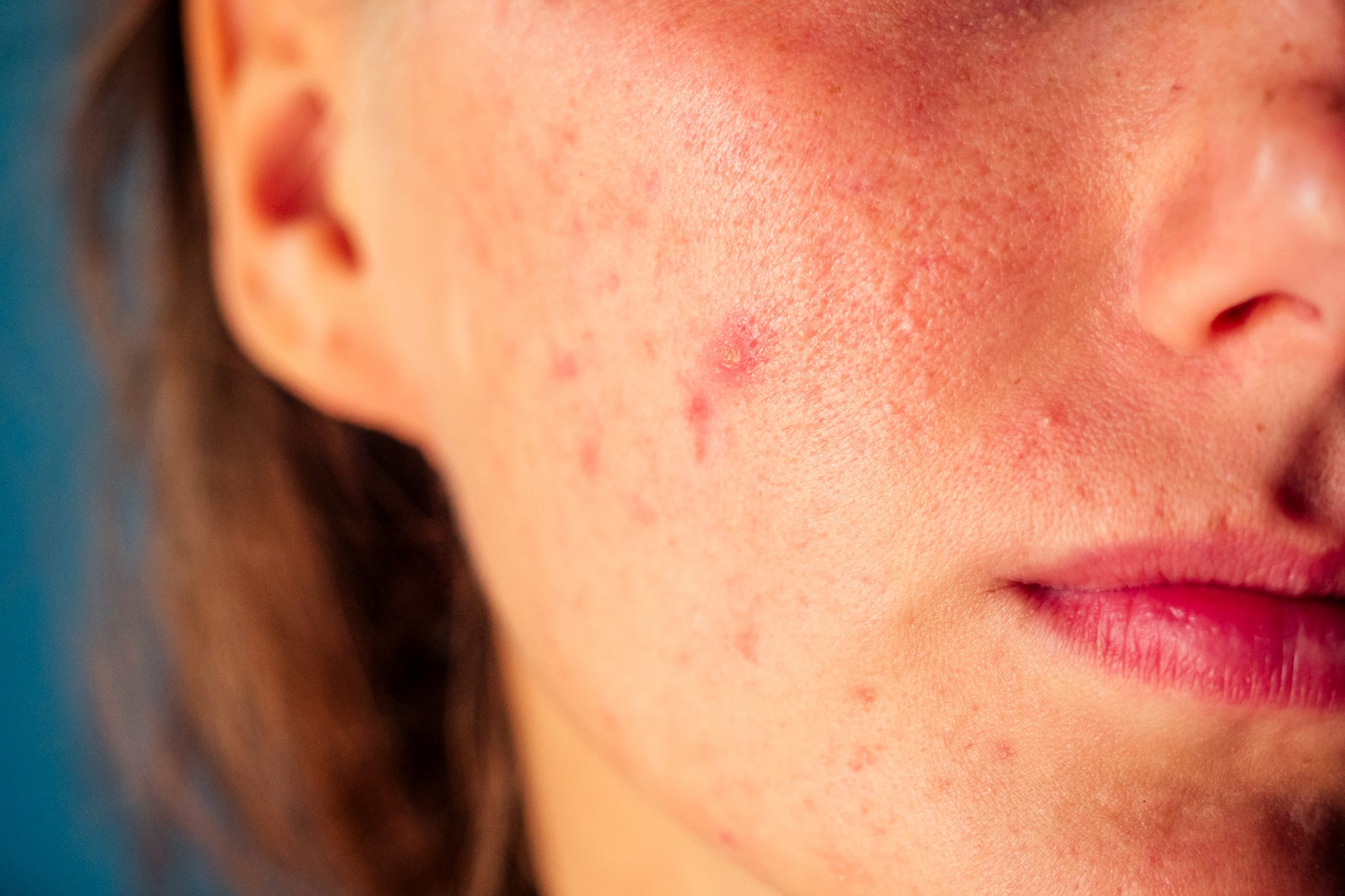 post-acne, scars and red festering pimples on the face of a young woman. concept of skin problems and harmonic failure.
